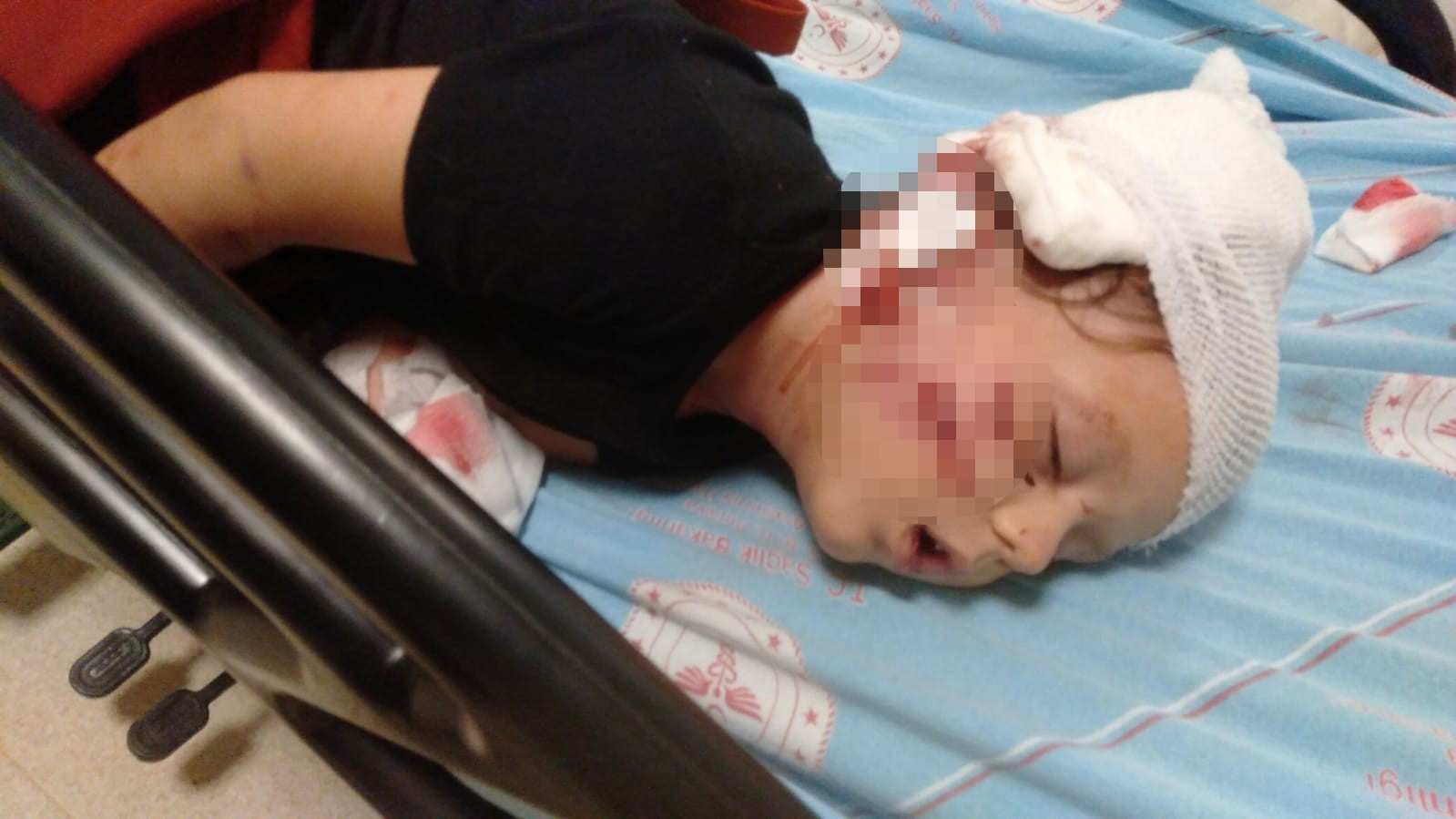 Antalya’da köpeğin saldırısına uğrayan 3,5 yaşındaki çocuk, ölümden döndü